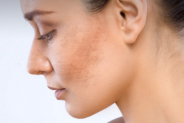 Tình trạng tăng sắc tố da là gì